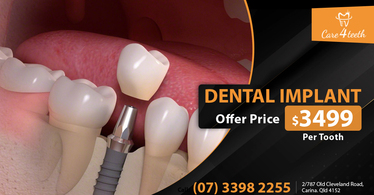 Dental Implant Carina Brisbane – Care 4 Teeth